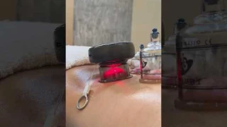 Heated muscle scraping tool combines cupping device for back recovery. #massagetherapy