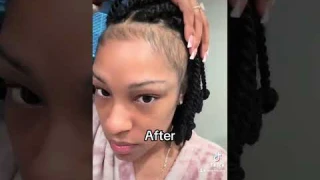 I grew my edges back using Minoxidil 5%  #minoxidil #hairloss #beforeandafter #hairgrowth #alopecia
