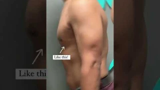 Gynecomastia surgery by Dr. Lyly at 6 weeks post-op