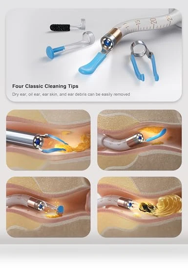 Earsight Plus Ear Wax Removal Tool Camera — Wax Removal, BEBIRD